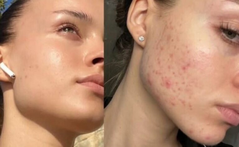 מה גורם לאקנה וכיצד מתמודדים עם ההשלכות הרגשיות? 971151.jpeg