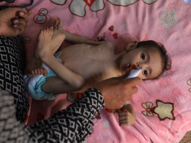 Aa 20250605 38188473 38188469 11monthold babys life at risk due to malnutrition in gaza 1749183532.jpg