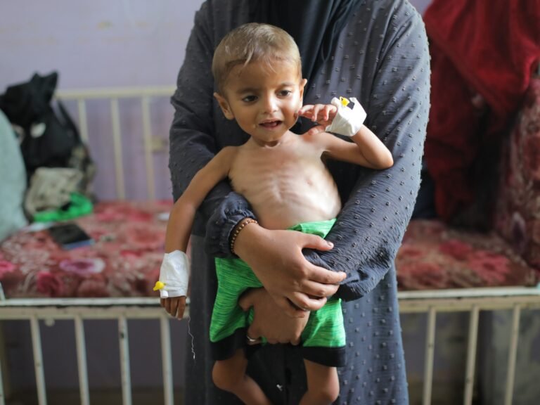Aa 20250813 38815916 38815902 malnourished gaza children treated with limited medical resources 1755079056.jpg